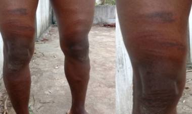 ലഹരി ഉപയോഗം വീട്ടില്‍ അറിയിച്ചു; 17കാരന് കൂട്ടുകാരുടെ ക്രൂരമര്‍ദനം