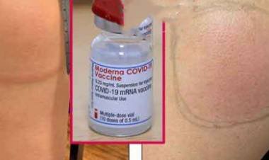 വാക്സിന്‍ എടുത്ത് ഒരാഴ്‌ച്ചക്കുള്ളില്‍ കൈകളില്‍ ചുവന്ന പരുക്കള്‍; കോവിഡ് ആം എന്ന് പേരു നല്‍കിയ ഈ പാര്‍ശ്വഫലം ആരോഗ്യത്തെ ബാധിക്കുകയില്ലെന്ന് ഡോക്ടര്‍മാര്‍; ഏതാനും ദിവസങ്ങള്‍ക്കകം ഇത് ചികിത്സിച്ച്‌ മാറ്റാനാവും; മോഡേണയുടെ വാക്സിനില്‍ മാത്രം കാണുന്ന പാര്‍ശ്വഫലത്തെ കുറിച്ച്‌ അറിയാം