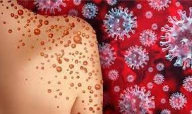 നെടുമ്പാശ്ശേരി വിമാനത്താവളത്തില്‍ എത്തിയ യാത്രക്കാരന് മങ്കിപോക്സ് ലക്ഷണം